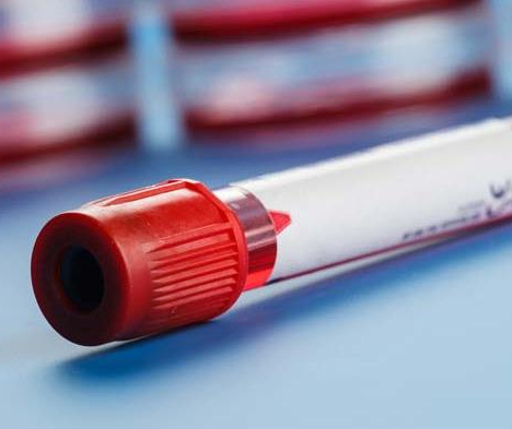 Determination of Fluoride EDTA and Oxalic Acid in Vacuum Blood Collecting Tube